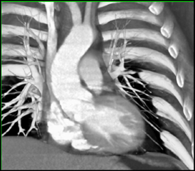 Dilated Aortic Valve - CTisus CT Scan