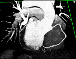 Nice View of Coronary Arteries - CTisus CT Scan