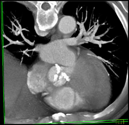 Calcified Aortic Valves - CTisus CT Scan