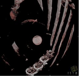 Aortic Valve Replacement (AVR) - CTisus CT Scan