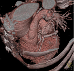 Coronary Vein - CTisus CT Scan