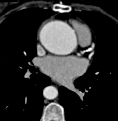 Calcified Plaque in Coronary Artery - CTisus CT Scan