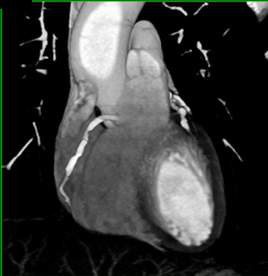 Calcified Extensive Plaque in the Coronary Arteries - CTisus CT Scan