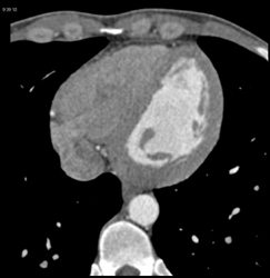 Normal Study - See the Opacity of Right Side of Heart - CTisus CT Scan