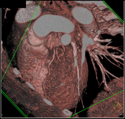 Plaque in Left Main Coronary Artery - CTisus CT Scan