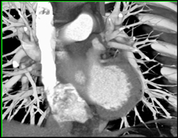 Diseased RCA - CTisus CT Scan