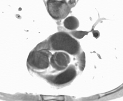 Bicuspid Aortic Valve - CTisus CT Scan