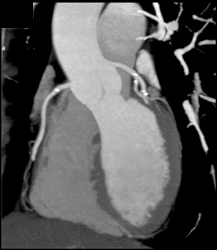 Plaque in Right and Left Coronary Artery - CTisus CT Scan