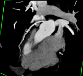 Calcified Plaque Without Stenosis - CTisus CT Scan