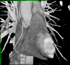 Minimal Plaque on Right Coronary Artery - CTisus CT Scan