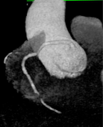 Pseudolesion in Right Coronary Aa - CTisus CT Scan