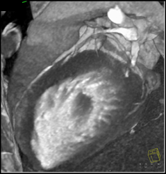 Stenosis in Left Coronary Artery - CTisus CT Scan