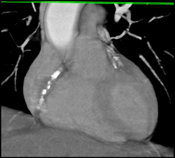 Extensive Calcified Plaque - CTisus CT Scan