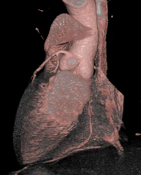 Normal MIP/VRT - CTisus CT Scan