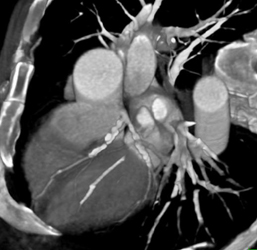 Extensive Coronary Aa Calcifications - CTisus CT Scan