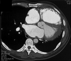 Large Right Ventricle - CTisus CT Scan