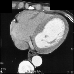 Nice Post Saline Chaser Right Heart - CTisus CT Scan