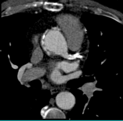 Prosthetic Aortic Valve - CTisus CT Scan