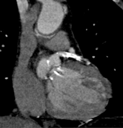 Extensive Plaque in LAD - CTisus CT Scan