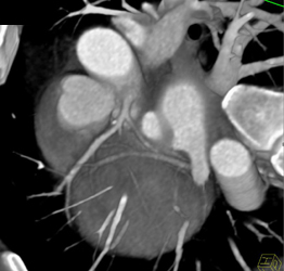 Normal Left Main Coronary Artery - CTisus CT Scan