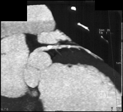 Disease in LAD With Normal Right Coronary Aa - CTisus CT Scan