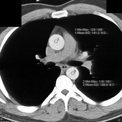 Timing for Bolus Injection Protocol - CTisus CT Scan