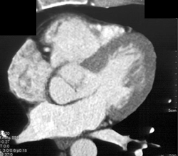 Normal Right Coronary Aa - CTisus CT Scan