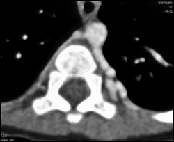 Pulmonary Venous Malformation - CTisus CT Scan