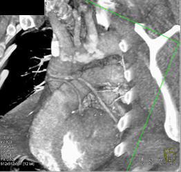 Patent Coronary Aa Graft - CTisus CT Scan