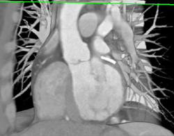 Coronary Aa Stent - CTisus CT Scan