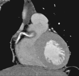 Soft Plaque in RCA - CTisus CT Scan