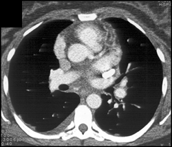 Left Sided SVC Empties Into the Coronary Sinus - CTisus CT Scan