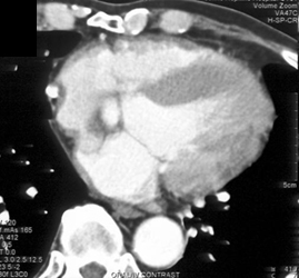 Saphaneous Vein Aneurysm - CTisus CT Scan