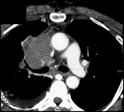 NSCLC Invades the SVC - CTisus CT Scan