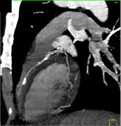 Multiple Calcified Plaques - CTisus CT Scan