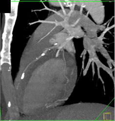 Stenosis LAD - CTisus CT Scan