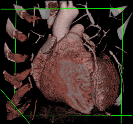 VRT and MIP of Coronary Arteries - CTisus CT Scan