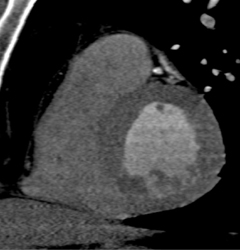 50% Stenosis LAD - CTisus CT Scan