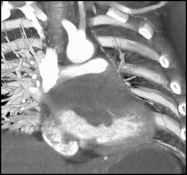 Sarcoma Invading Left Side of Heart-left Atrium - CTisus CT Scan