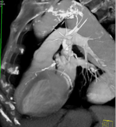 Coronary Artery Calcification in LAD - CTisus CT Scan