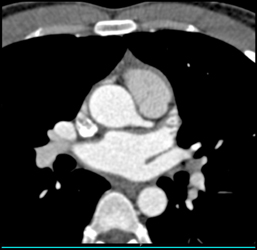 Minimal Plaque in LAD - CTisus CT Scan