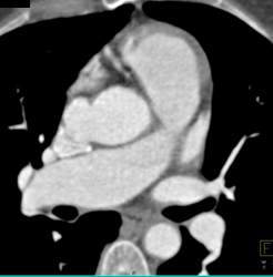 Pseudoaneurysm Off of Ascending Aorta - CTisus CT Scan