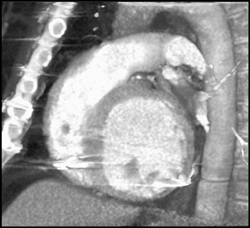 Poor Lv Function - CTisus CT Scan