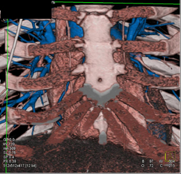 Automated Segmentation of the Coronary Arteries - CTisus CT Scan