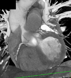 Stent in RCA - CTisus CT Scan