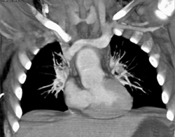 Single Ventricle With Common Trunk - CTisus CT Scan