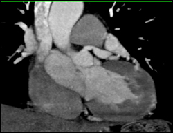 Aneurysm of Left Main Coronary Aa - CTisus CT Scan