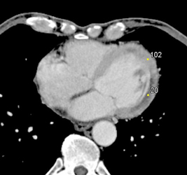 Acute Myocardial Infarction - CTisus CT Scan