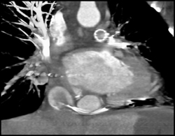 Shunt Poorly Opacified - CTisus CT Scan