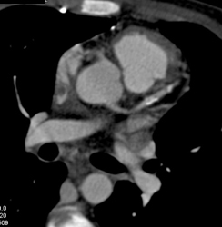 50% Stenosis in LAD - CTisus CT Scan